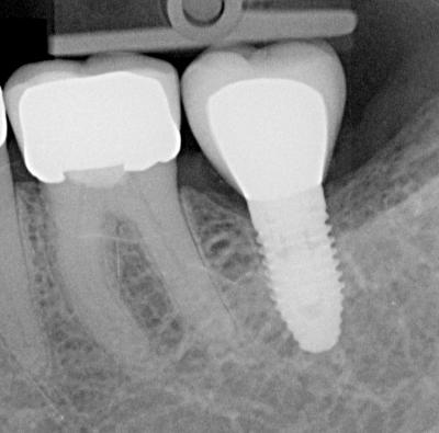 Implantate