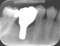 Implantat von Straumann mit Krone (Ca. Preis ohne Knochenaufbau)