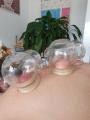 Cours de ventouses basic et avancé, formation en Médecine Chinoise MTC, Sion