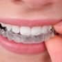 Ortho Folio, Zahnkorrekturen bei Jugendlichen und Erwachsenen