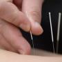 Acupuncture - Cabinet Énergie Vitale, médecine traditionnelle chinoise à Genève
