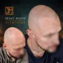 Micropigmentation capillaire résultat cicatrisé 3 ans avant retouche