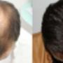 Transplantieren schonend Haare Basel Region Narben Haartransplantation