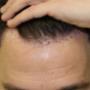 Fue Methode Basel Region Haare Haarverpflanzung