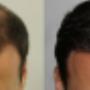 Fue Methode Basel Region Haare Haarverpflanzung