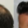 Fue Methode Basel Region Haare Haarverpflanzung