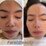 FarahBeauty Gland -  Microneedling