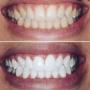 FarahBeauty Gland - Blanchiment dentaire