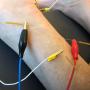 ITES Intratendinöse Elektrostimulation; EA Elektroakupunktur an der Achillessehne