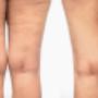 Cellulite vorher / nachher