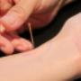 Akupunktur Therapie, TCM, Alternative Medizin, Naturheilkunde