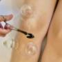 Moxatherapie, Moxibustion, Moxa, Schröpfen, TCM, Alternative Medizin, Naturheilkunde, Tibetische Medizin