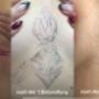 Tattooentfernung