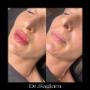 Dr Meral Saglam - Médecin esthétique Champel Genève - Injections lèvres