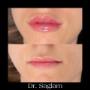 Meral Saglam - Médecin esthétique Genève - Lèvres avant/après