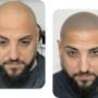 micropigmentation