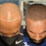 scalp micropigmentation