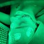 Lichttherapie