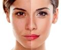 HydraFacial + Microneedling Paket