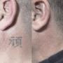 Tattooentfernung Schweiz