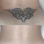 Tattooentfernung Schweiz