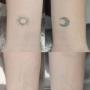 Tattooentfernung Schweiz