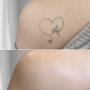 Tattooentfernung Schweiz