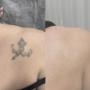 Tattooentfernung Schweiz