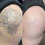 Tattooentfernung Schweiz