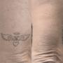 Tattooentfernung Schweiz